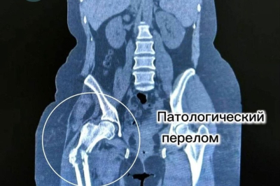 В Татарстане впервые заменили бедренную кость пациентке с саркомой